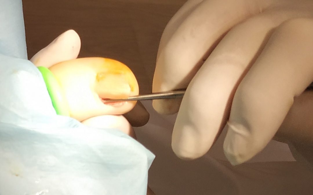 CIRUGÍA DE UÑA ENCARNADA