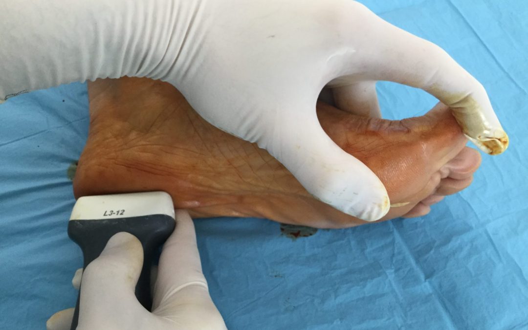 CIRUGÍA FASCITIS PLANTAR