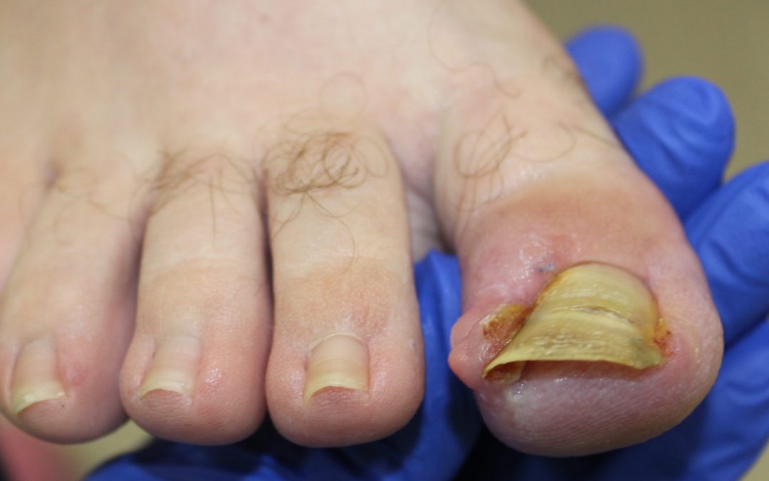 ¡Me duele mucho la uña encarnada!