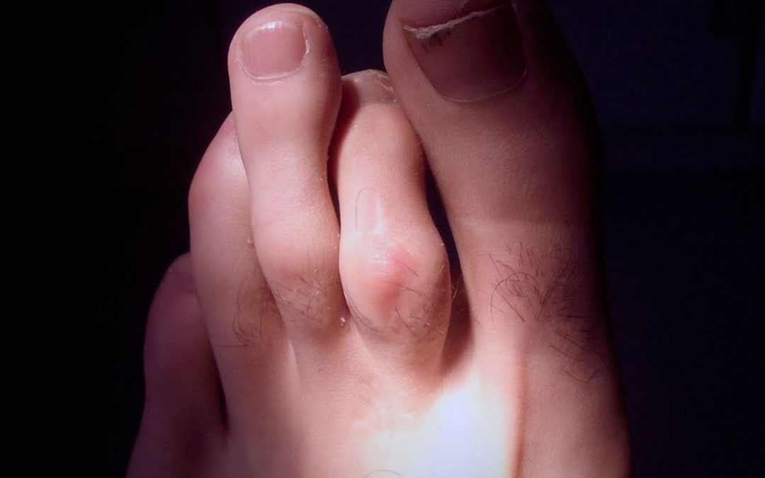 ¿Qué hago con estos dedos en garra?