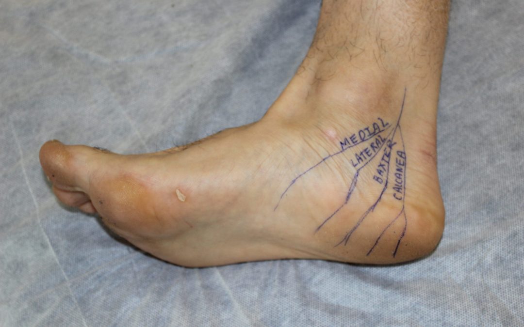 ¿Fascitis?: autoexplorate